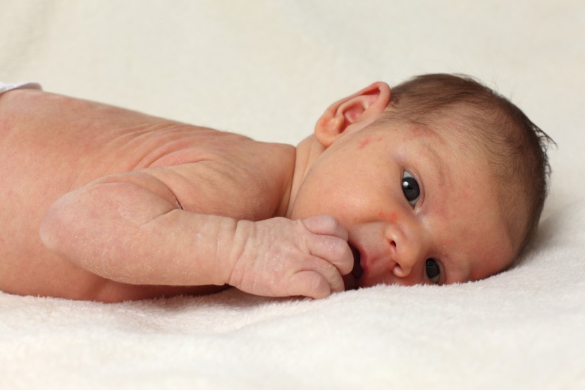 Neurodermitis bei Kindern – das sollten Eltern wissen