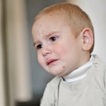 Neurodermitis: große Belastung für die Kleinen