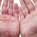 Psoriasis: Was tun, wenn Schuppenflechte im Alter auftritt?