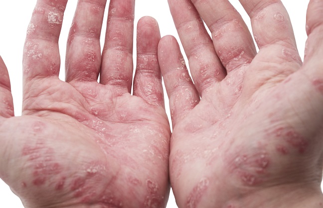 Psoriasis: Was tun, wenn Schuppenflechte im Alter auftritt?