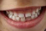 Zahnfehlstellung schon im Kindesalter beheben